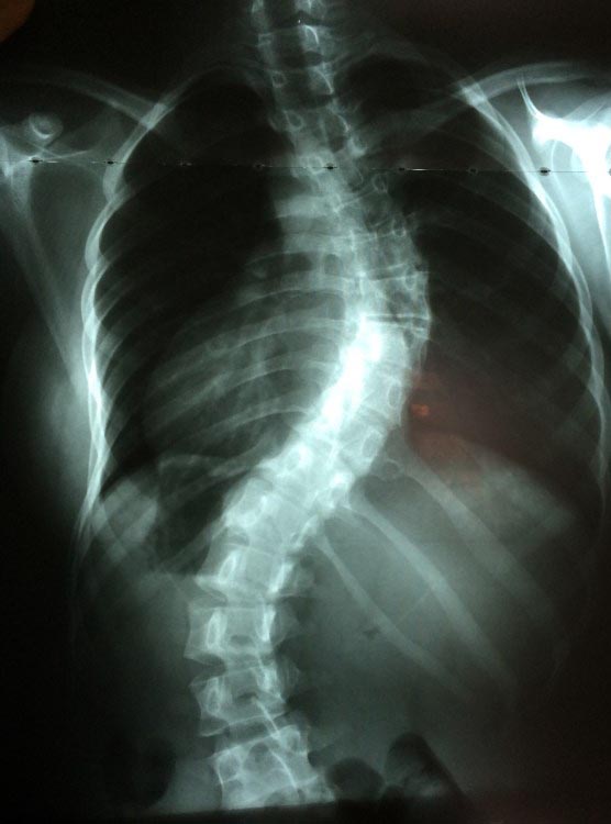 The extreme spine curvature of a WPP patient, typical of the severity of scoliosis